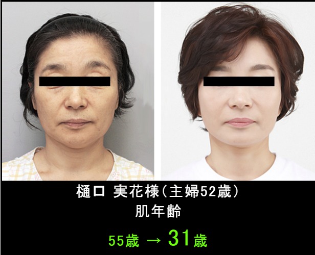 シロニー Before After