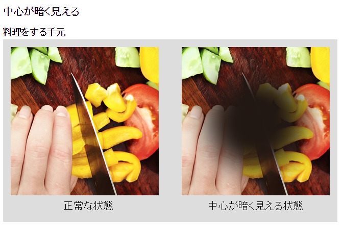 加齢黄斑変性症